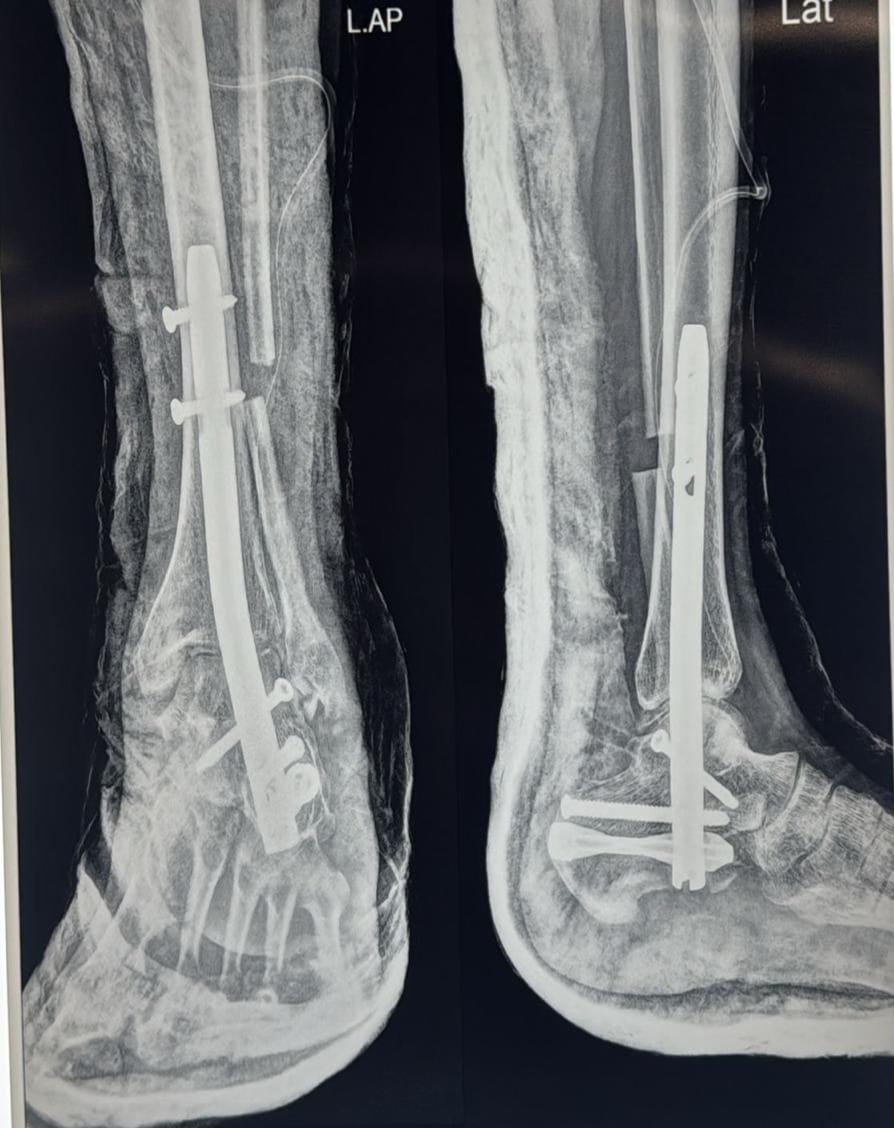 Complex distal tibia fracture